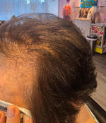 Real customer before photo showing severe hair thinning and sparse coverage on crown – RUTAM Ageless Revitalizing Scalp & Volume Mist supports scalp microbiome to combat daily hair loss