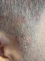 Close-up of scalp showing flaking, dryness and irritation near temple – RUTAM Ageless Revitalizing Scalp & Volume Mist addresses scalp conditions, dandruff, seborrhea and hair shedding